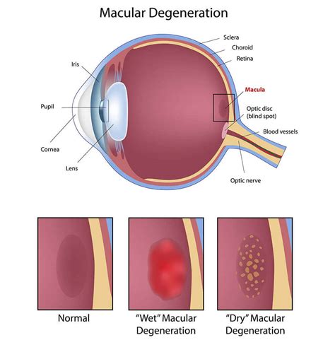 amd eye disease|list of degenerative eye diseases.